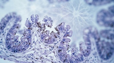 腸道異常早於大腦病變　研究指是阿茲海默症預測新線索