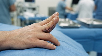 澳洲完成腳趾移植重建拇指手術　女子重拾抓握能力　預估可恢復八成拇指功能