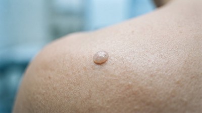 皮膚冒「黏著」蠟狀斑塊？醫解密常見「老人斑」與潛在警訊