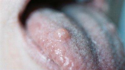 年輕族群口腔癌警訊：舌部白色病變多見　腫瘤深度成預後關鍵