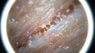 醫學新突破：蛋白質阻斷療法 望修復受損膝蓋免換關節