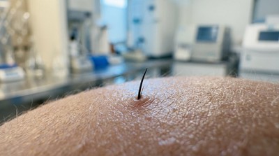 治療2歲以上圓形禿患童與成人 Legacy Healthcare 新藥獲FDA突破性認定